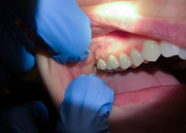 Best Root Canal Emergency Dentist  in St Martinville, LA